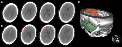 Bloody fluids located between the temporal muscle and targeted cerebral cortex affect the establishment of indirect collaterals in Moyamoya disease with surgical bypass: A case-control study